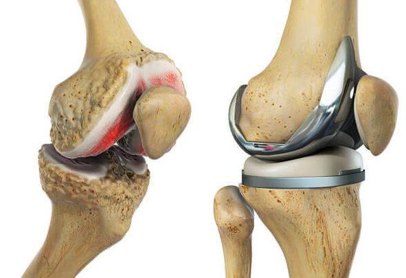 Knee & Hip Replacement