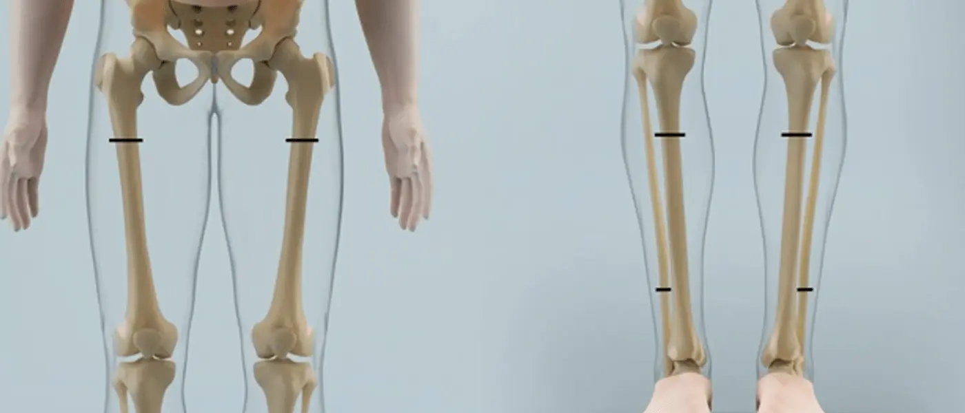 Limb Lengthening Surgery